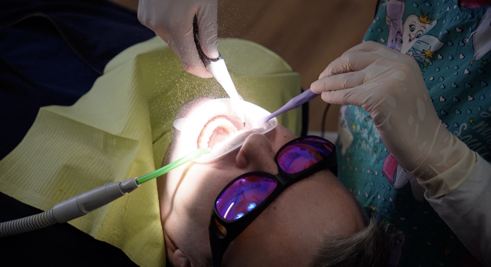 Odstranění zubního kamene při dentální hygieně