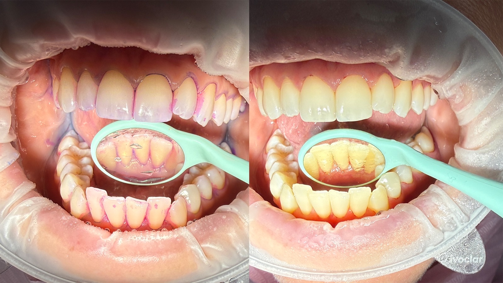 Zuby po profesionální dentální hygieně
